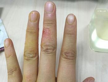 湿疹预防要做好哪几点